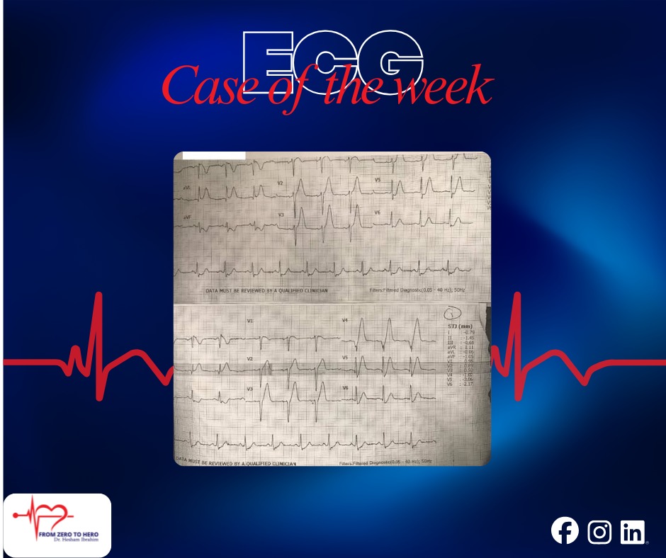 Prehospital ECG Chest Pain Case