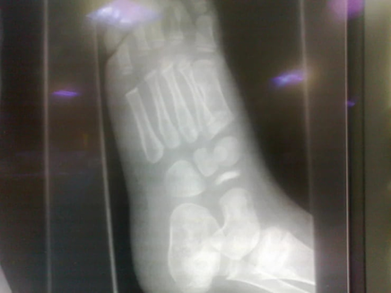 X-ray of the affected foot