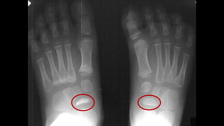 Comparative radiographic appearance in Köhler Disease